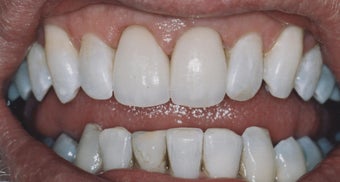 Dental Crowns and Teeth Whitening after 485403