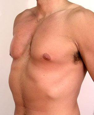 Male Chest Enhancement after 525473