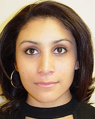 Rhinoplasty after 281937