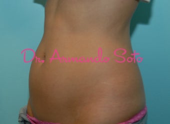 Coolsculpting by Zeltiq before 419220