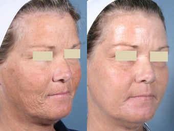 Laser Resurfacing before 104662