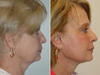Facelift and upper and lower blepharoplasty. after 228963