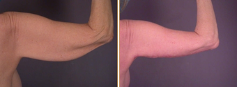 Arm Lift before 272284