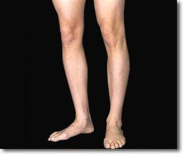 Calf Implant before 566017