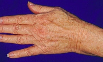 Sclerotherapy for hands after 371746
