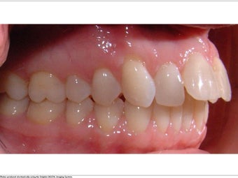 Invisalign before 362339