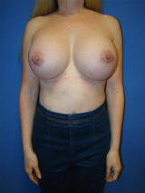 Extra Large Breast Augmentation Surgery after 125016
