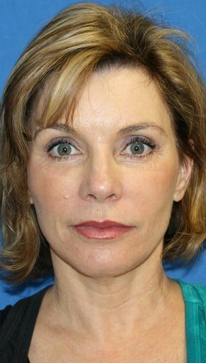Facelift with Extended Necklift, Lateral Browlift, Fat Transfer, and Skin Pinch after 540338