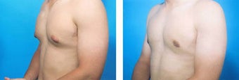 Liposuction before 636167
