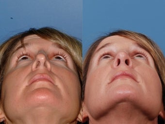 Revision rhinoplasty after 355710