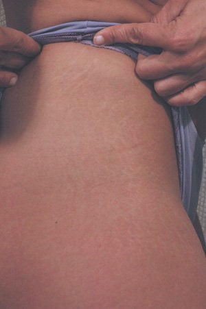 Laser for Stretch Marks after 199402