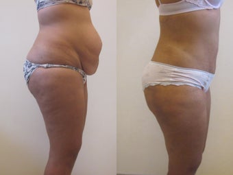 Tummy Tuck after 220788