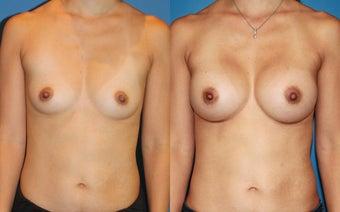 Breast Augmentation before 310716
