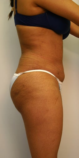 Liposuction with fat grafting / transfer to buttocks after 535831