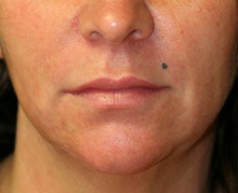 Lip Augmentation with Permalip before 380417