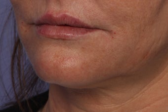 Perlane L to Lips after 309740