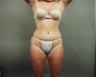 Liposuction before 304419