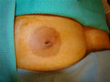 Inverted Nipple Repair before 124946