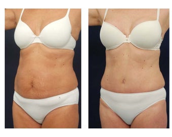 Abdominoplasty - Tummy Tuck after 396160