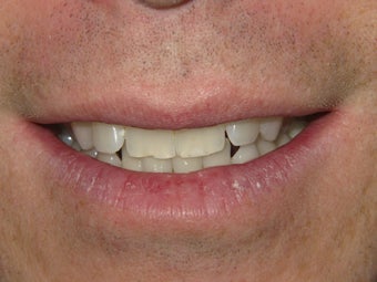 KOR Deep Bleaching System after 398116