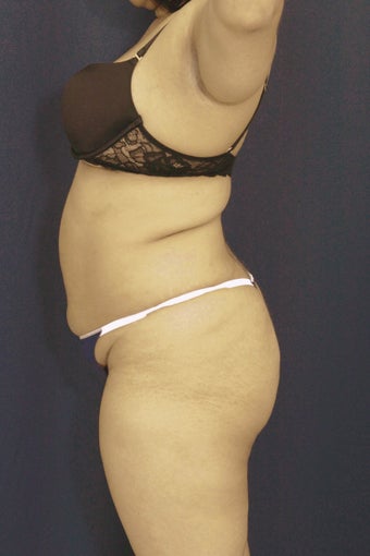 Brazilian Butt Lift surgery (liposuction to multiple areas and fat grafting to buttock) 606611