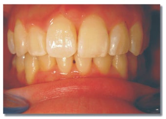 Invisalign for severe crowding/ non extraction after 310074
