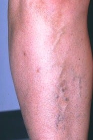 Sclerotherapy on Leg before 370427