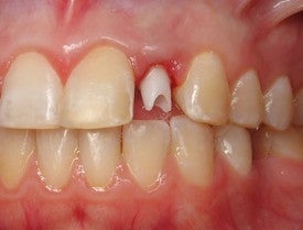 Dental Implant for Missing Lateral Incisor 504324