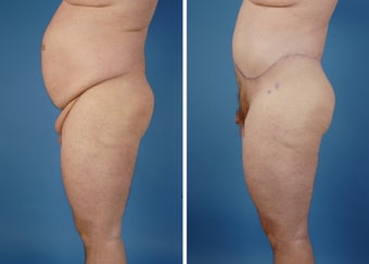 Upper & Lower Body Lift after 335976