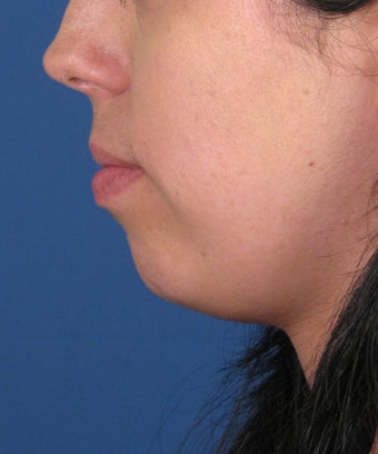 Chin Implant 534045