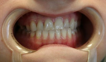 Upper arch make over with veneers and crowns before 625407