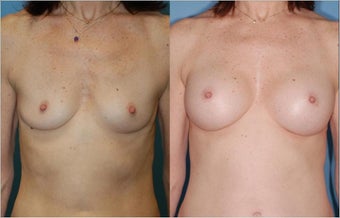 Breast Augmentation - Silicone before 127492