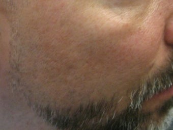 CO2 Fractionated Laser Resurfacing before 272016