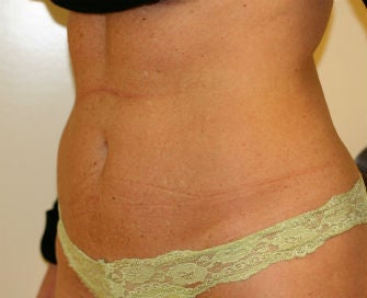 Mini-abdominoplasty 493653