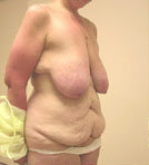 Breast Reduction Surgery and Tummy Tuck before 152005