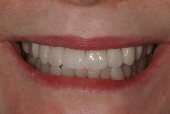 Full Mouth Reconstruction after 217470