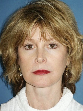 Facelift, Endoscopic Browlift, Upper and Lower Blepharoplasty, Lip Augmentation with Alloderm Grafts after 248832