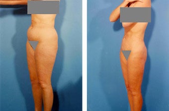 Liposuction before 636107