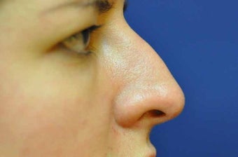 Non-Surgical Rhinoplasty before 513480