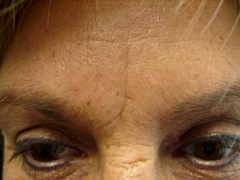 Immediate Improvement of a Forehead Wrinkle before 271680