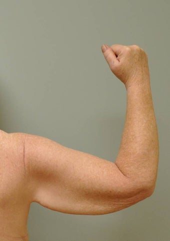 Arm Lift (Brachioplasty) before 465746
