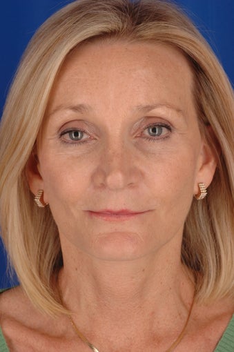 Endoscopic brow lift, open neck lift, facelift, lower blepharoplasty and fat transfer to lips after 385614