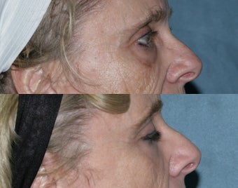 Fraxel repair with C02/Erbium lasers for upper lip wrinkles before 104332