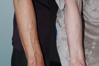 Fraxel Restore Dual Laser Treatment before 481746