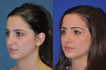 Rhinoplasty before 256039