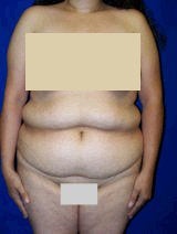 Extended Tummy Tuck Surgery (Tummy Tuck with Back Lift) before 147831