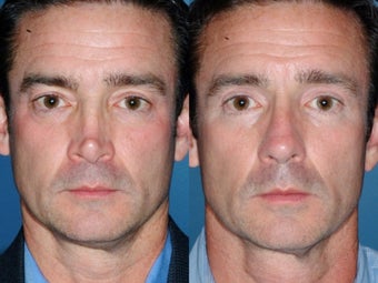 Revision rhinoplasty before 334286