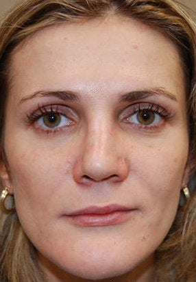 Silikon-1000 for lip augmentation and non-surgical nose job with IPL PhotoFacial after 95162