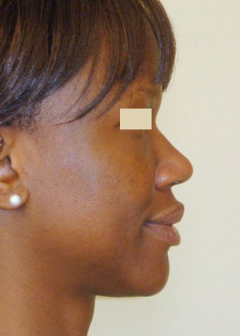 African-American Rhinoplasty before 104227