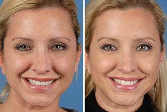 Botox Cosmetic & Restylane before 356613